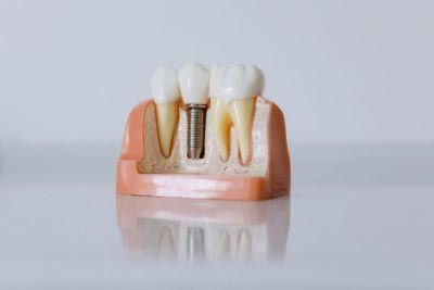 model of how dental implants work
